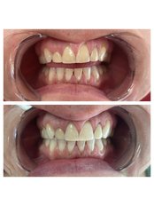 Teeth Whitening - a-dent Dental Clinic