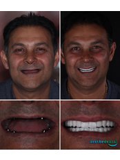 All-on-6 Dental Implants - Aesthedental