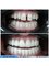 Akdeniz İnci Dental Clinic - Metal Supported Porcelain Crowns 