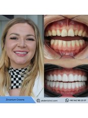 Dental Crowns - Akdeniz İnci Dental Clinic