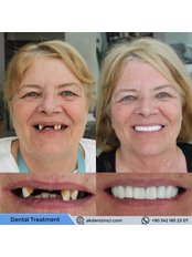 Dental Implants - Akdeniz İnci Dental Clinic