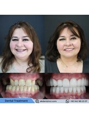 Dental Bridges - Akdeniz İnci Dental Clinic