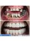 Akdeniz İnci Dental Clinic - Metal Supported Porcelain Crowns 