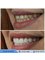 Akdeniz İnci Dental Clinic - Laminate Veneers 