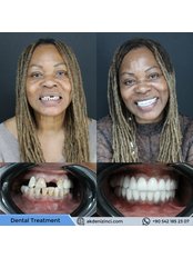 Dental Bridges - Akdeniz İnci Dental Clinic