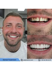 Dental Crowns - Akdeniz İnci Dental Clinic