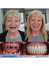 Single Implant - Akdeniz İnci Dental Clinic