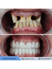 Single Implant - Akdeniz İnci Dental Clinic