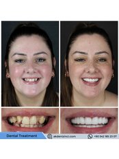 Zirconia Crown - Akdeniz İnci Dental Clinic