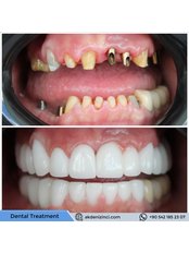 Dental Implants - Akdeniz İnci Dental Clinic