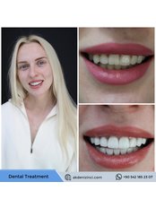 Porcelain Veneers - Akdeniz İnci Dental Clinic