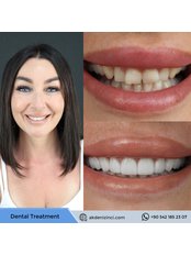 Veneers - Akdeniz İnci Dental Clinic