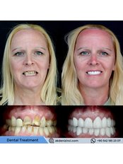 Porcelain Crown - Akdeniz İnci Dental Clinic