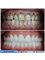 Akdeniz İnci Dental Clinic - Zirconium Crowns  