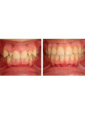 Orthodontics - Antalya Ortodonti Ağız ve Diş Sağlığı Polikliniği
