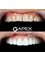 Apex Dental Turkey - Smile Makeover 