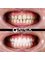 Apex Dental Turkey - E-max Crown 