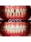 Apex Dental Turkey - Smile Makeover 