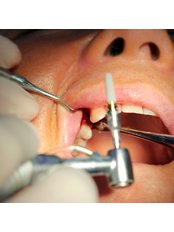 Dental Implants - ASV Medical
