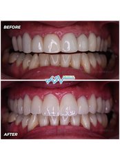 Dental Crowns - ASV Medical