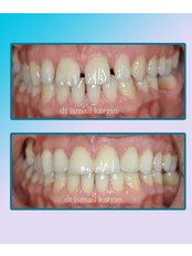 Zirconia Veneers/ Crowns - BeyazAda Dental Clinic