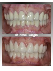 Full Mouth Rehabilitation - BeyazAda Dental Clinic