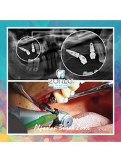 Dental Implants - Center Dental Clinic