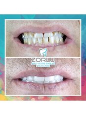 Zirconia Crown - Center Dental Clinic