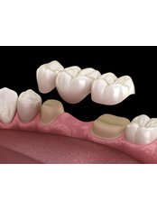 Dental Bridges - DCI Dental Clinic