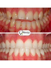 Orthodontics - Denta Antalya