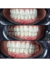 Porcelain Crown - Dental Aesthetic Turkey