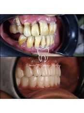 Dental Implants - Dental Aesthetic Turkey