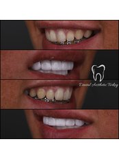 Zirconia Crown - Dental Aesthetic Turkey