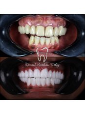 Dental Implants - Dental Aesthetic Turkey