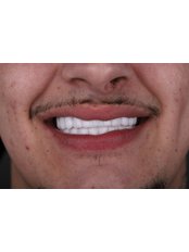 Hollywood Smile - Dental Aesthetic Turkey