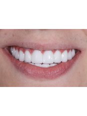 Porcelain Crown - Dental Aesthetic Turkey