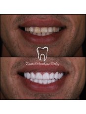 Zirconia Crown - Dental Aesthetic Turkey