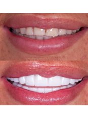 Hollywood Smile - Dental Design Turkey