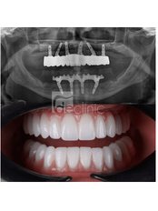 All-on-4 Dental Implants - Dental Excellence Turkey