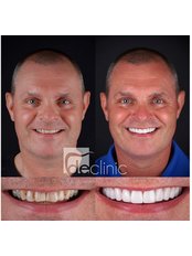 Hollywood Smile - Dental Excellence Turkey