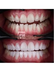 Full Mouth Rehabilitation - Dental Excellence Turkey