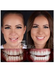 Zirconia Crowns - Dental Excellence Turkey