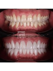 Zirconia Crowns - Dental Excellence Turkey