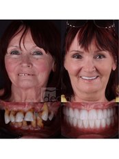 Dental Implants - Dental Excellence Turkey