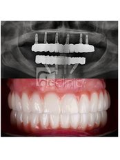 All-on-6 Dental Implants - Dental Excellence Turkey
