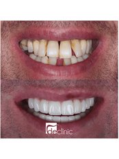 Dental Implants - Dental Excellence Turkey