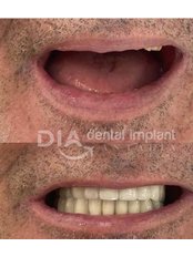 Dental Implants - Dental Implant Antalia