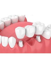 Dental Bridges - Dental Net Turkey