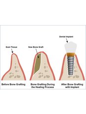Bone Graft - Dental Net Turkey