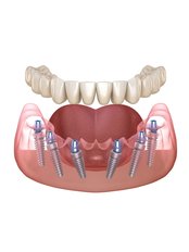 All-on-6 Dental Implants - Dental Net Turkey